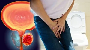 Prostate Cancer Treatment in Mulund